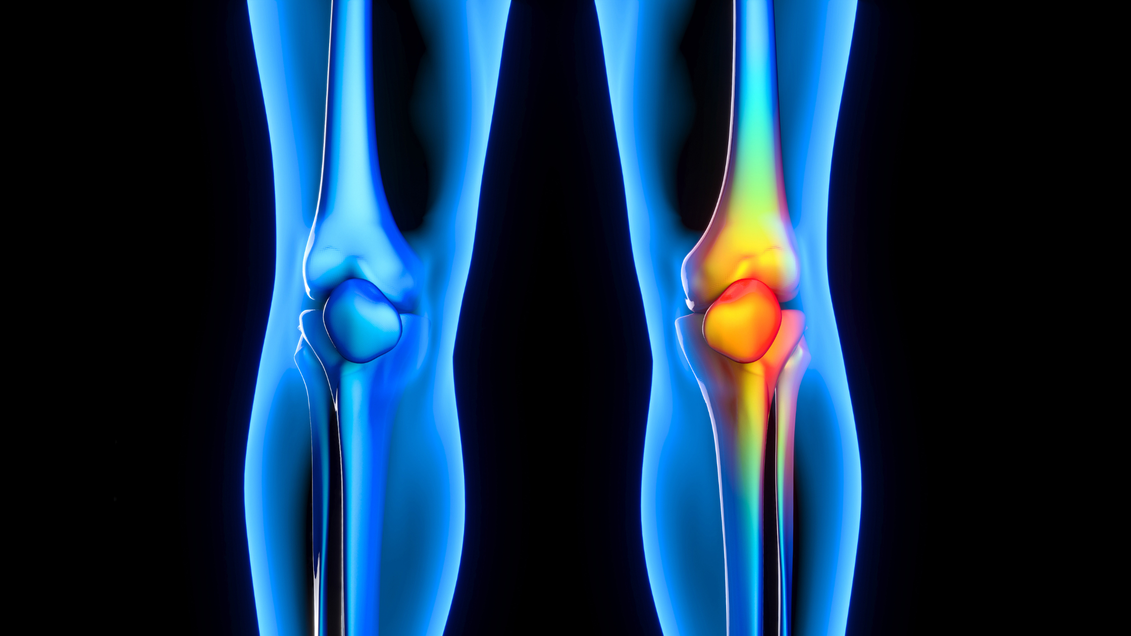 arthritis pain management