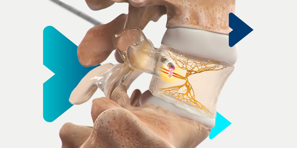 intracept procedure