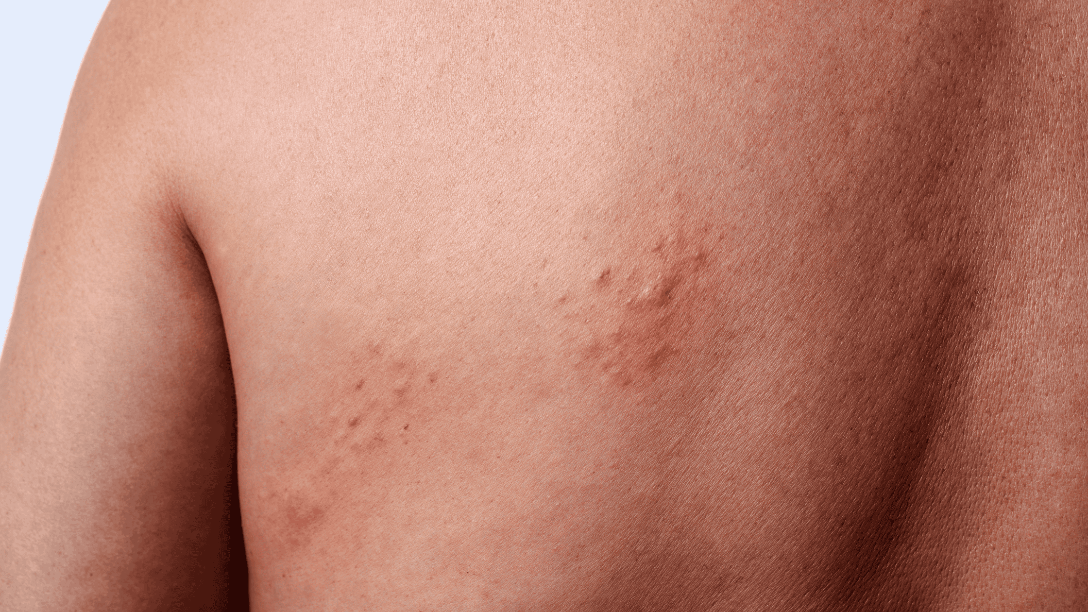 shingles cause muscle pain
